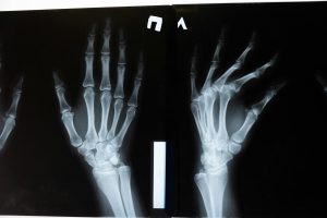 x ray of the hands
